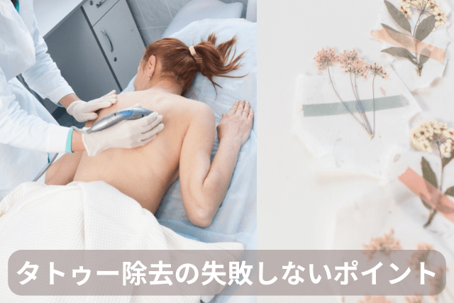 タトゥー除去で失敗しないポイント