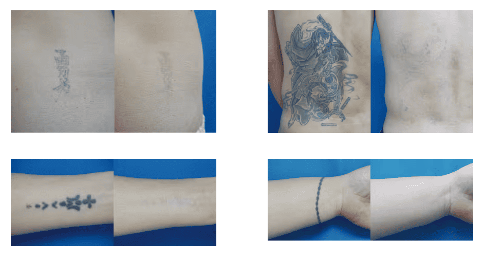 ガーデンクリニック、タトゥー除去の症例写真